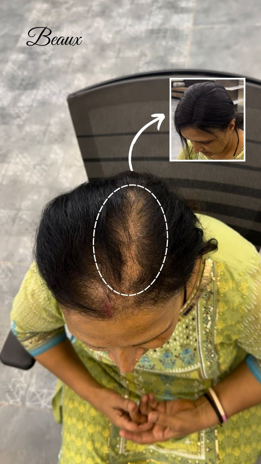 1.5X5 Monofilament topper